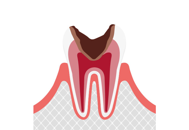 神経まで進行したむし歯
