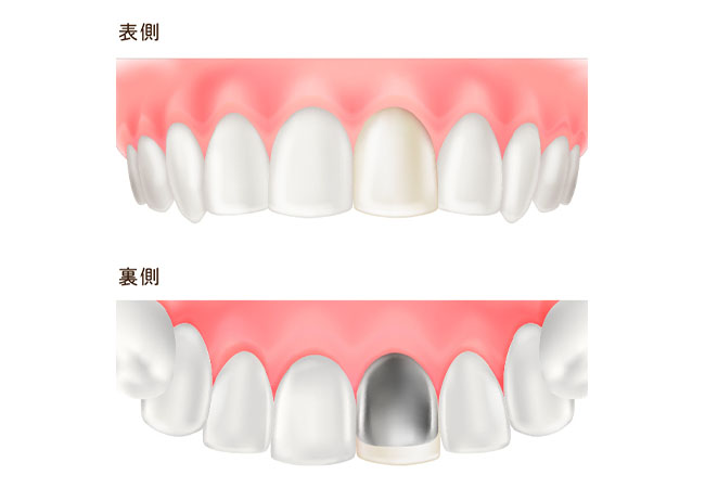 硬質レジン前装冠