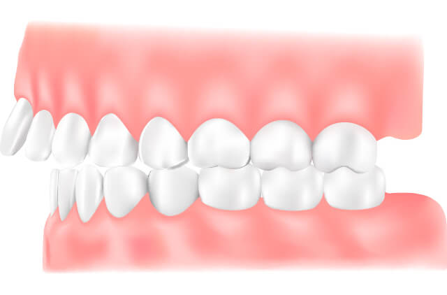 上顎前突のイラスト