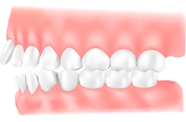 上下顎前突のイラスト