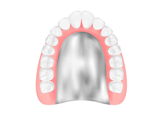 コバルトクロム床義歯