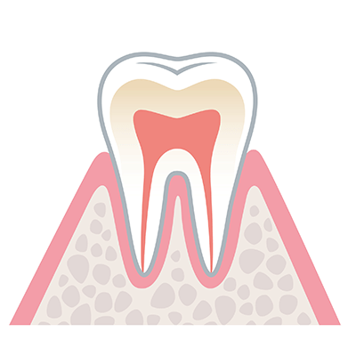 歯周病の進行01