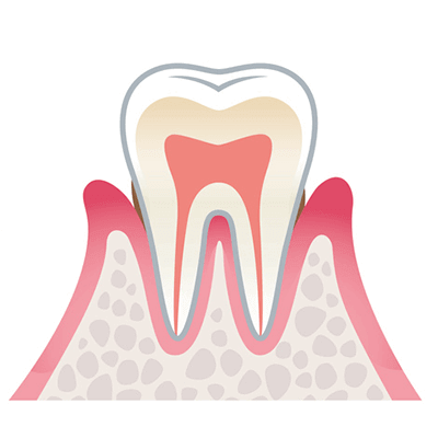 歯周病の進行02