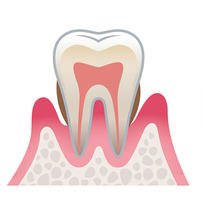 歯周病の進行03