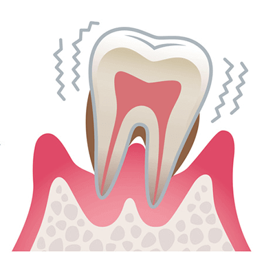 歯周病の進行04