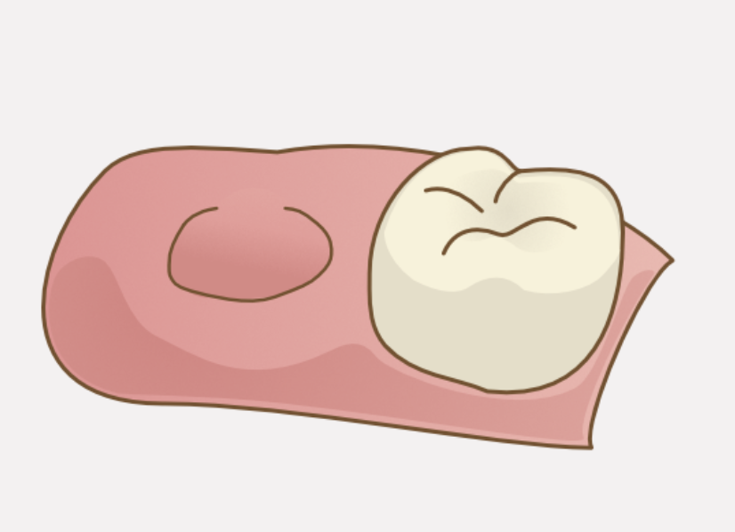 歯を抜いた後はどうする？