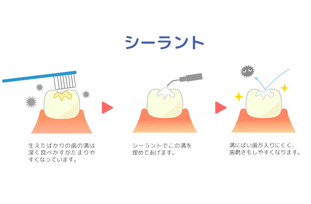 シーラント